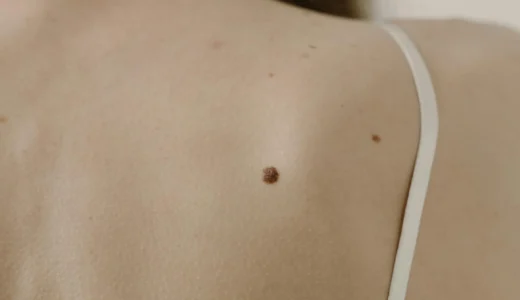 背中ニキビは皮膚科で治す！原因・治療法・自宅ケアを徹底解説