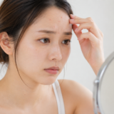おでこのニキビを気にしている女性
