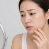 顎のニキビを気にして顔を触っている女性