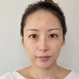 おでこにニキビがある女性