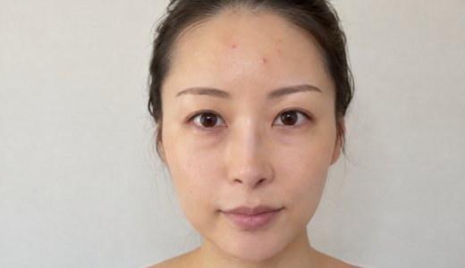ニキビは皮膚科でどれくらいで治る？治療期間の目安と経過を解説