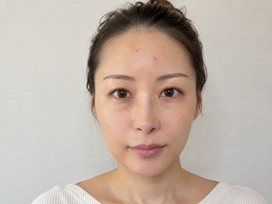 おでこにニキビがある女性