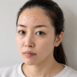 おでこにニキビが複数ある女性
