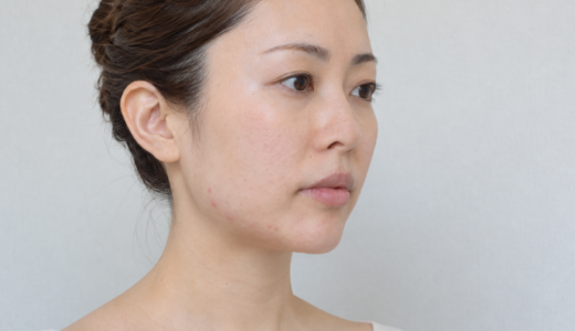 中学生のニキビはオンライン診療で保険適用？治療の流れと注意点