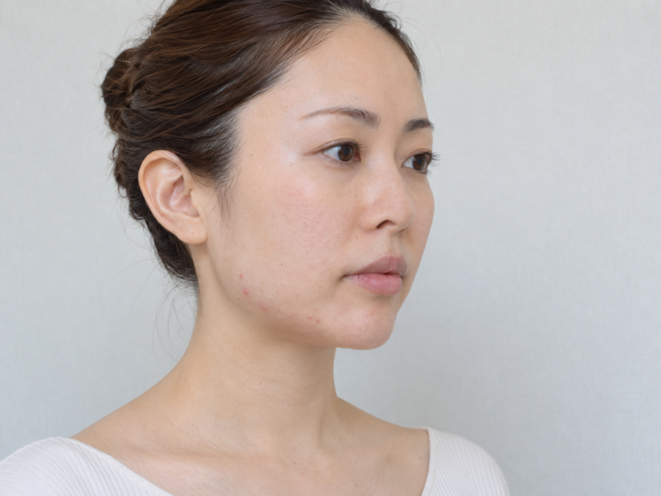 フェイスラインにいくつかニキビがあるまとめ髪の女性