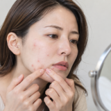 フェイスラインのニキビをつぶそうとする女性