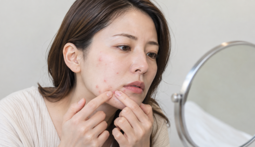 ニキビのオンライン診療は保険適用で安い？費用や流れを解説