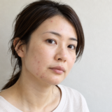 顔にいくつかのニキビがある女性