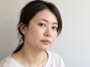 顔にいくつかのニキビがある女性