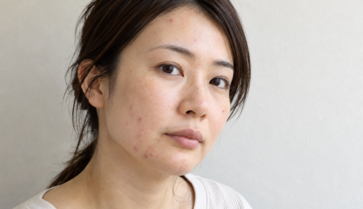 中学生のニキビが皮膚科でも治らない理由と正しい対処法